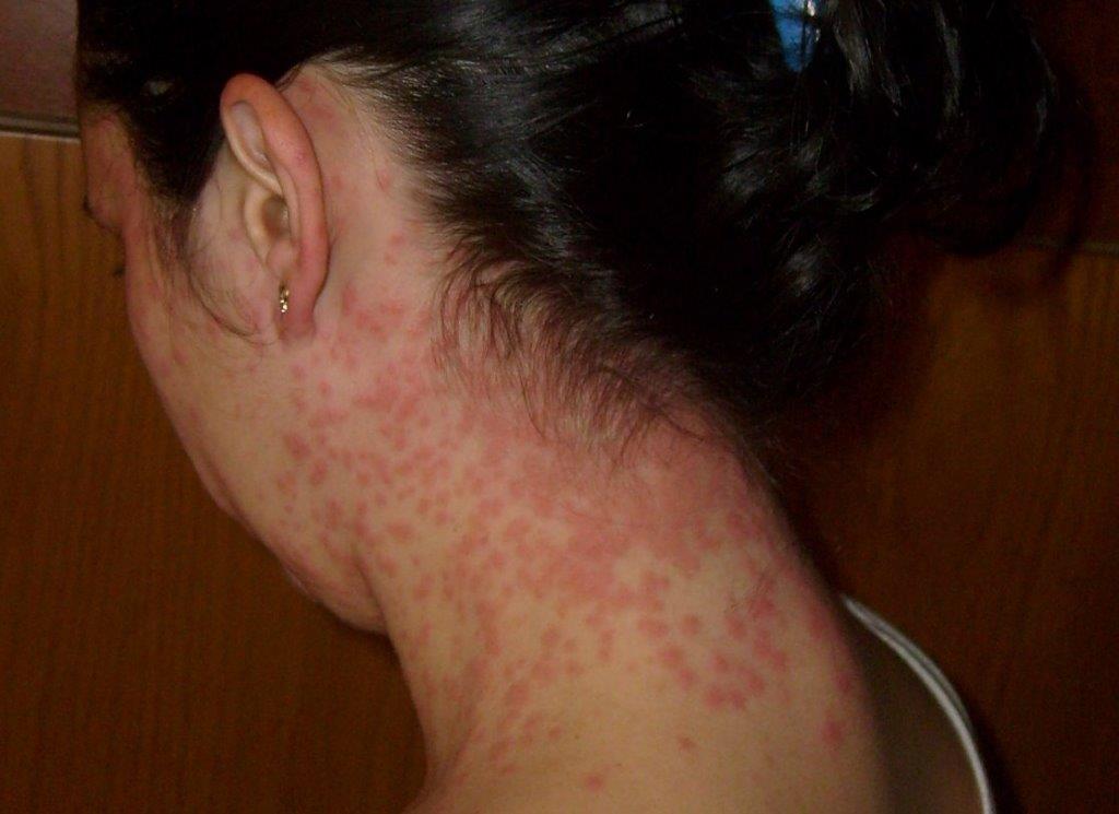 hives-in-children-urticaria-symptoms-and-treatment-for-parents-goodrx