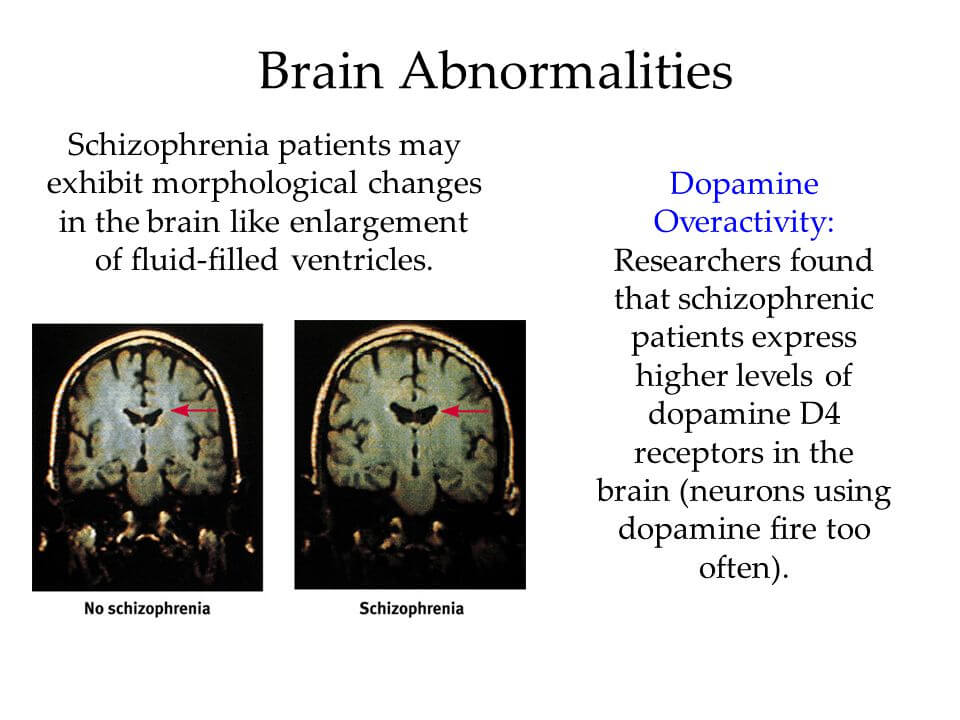 Signs And Symptoms Of Childhood Schizophrenia